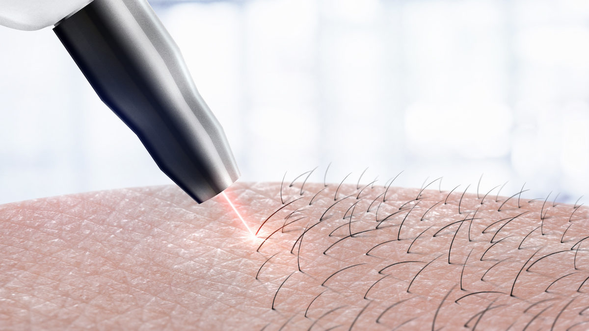 How Much Does It Cost To Do Laser Hair Removal