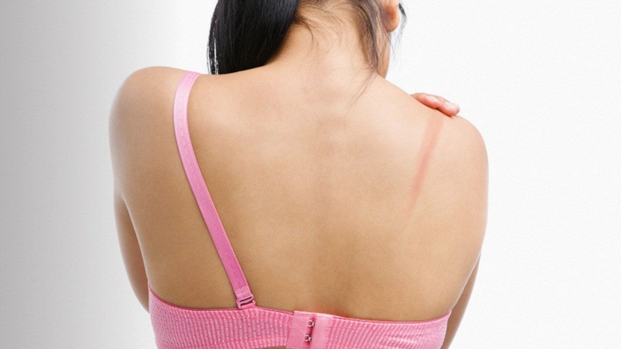 How To Get Rid Of Bra Marks