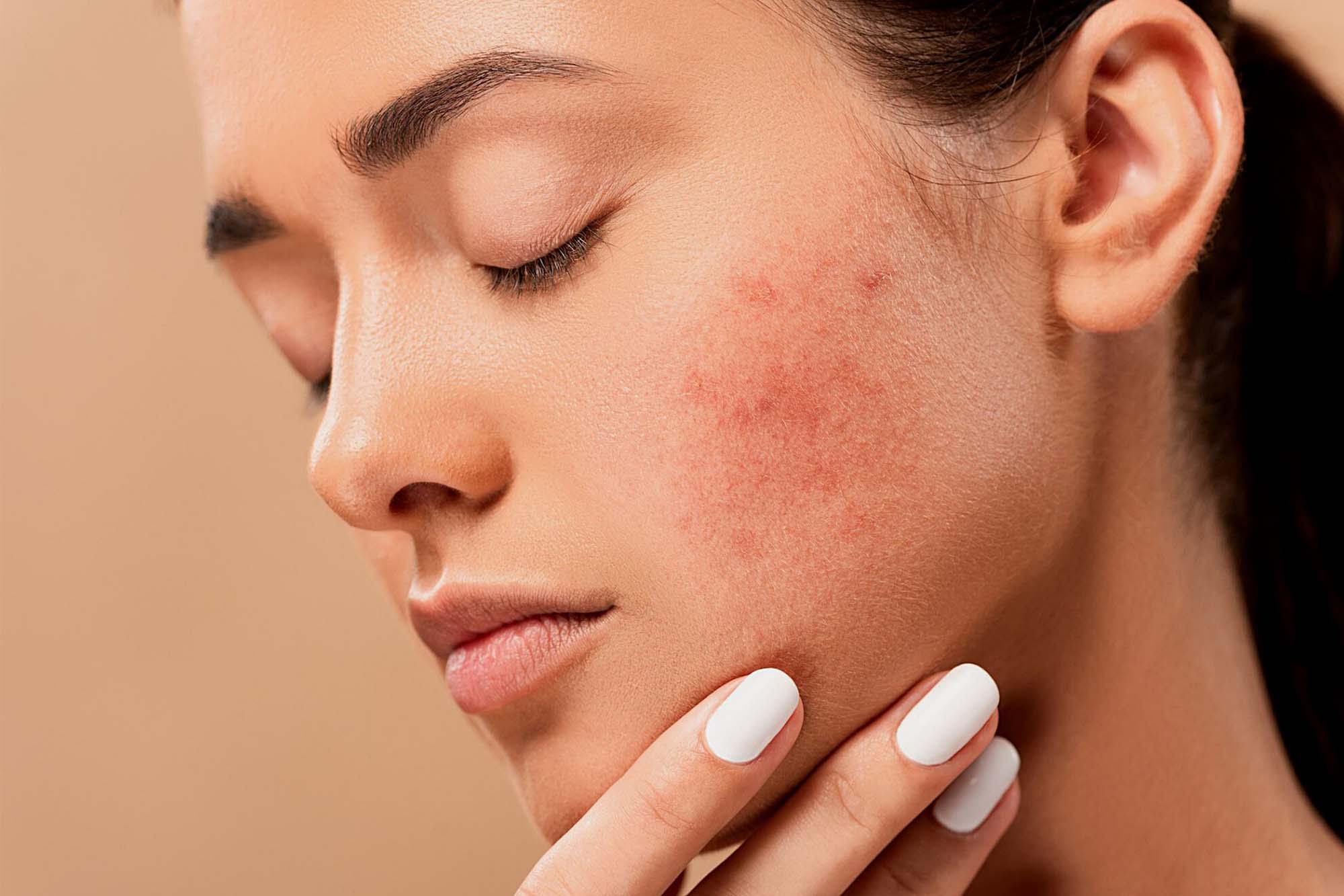 How To Treat Acne After Laser Hair Removal